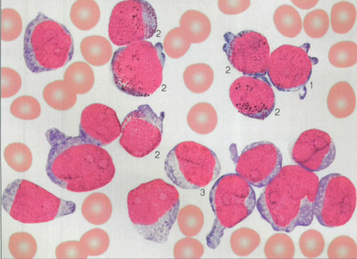 图201 慢性粒细胞白血病加速期骨髓象-血液学细胞学-医学